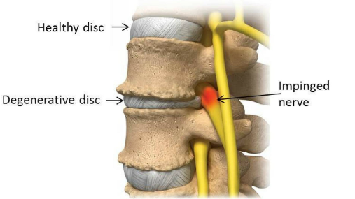 Degenerative Disc Disease