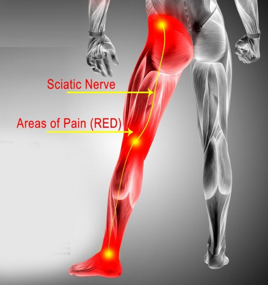 Home Remedies for Sciatica
