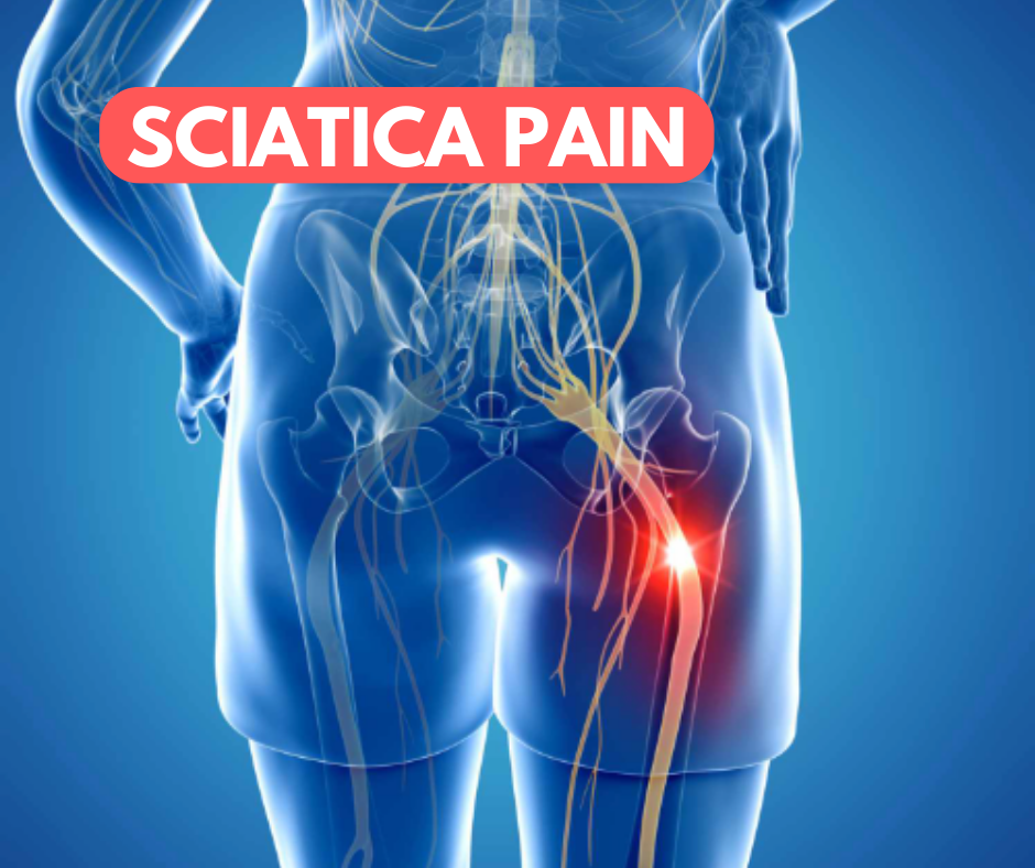 Sciatica - Its Causes , symptoms, prevention and treatment