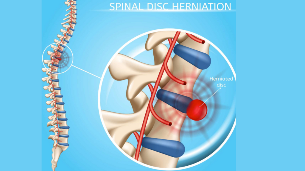 Herniated Disc: Causes, Symptoms, Treatment Options and Supplements