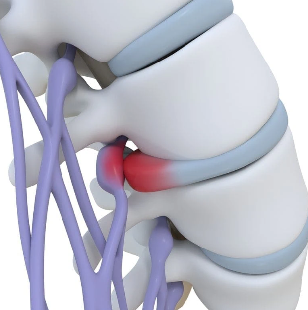 Understanding Disc Bulge: Causes, Symptoms, and Treatments