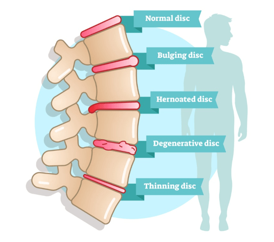 Disc Bulge vs. Herniated Disc