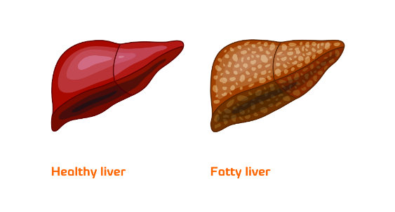 Fatty liver- Its Causes, Symptoms, Diagnosis & Treatment