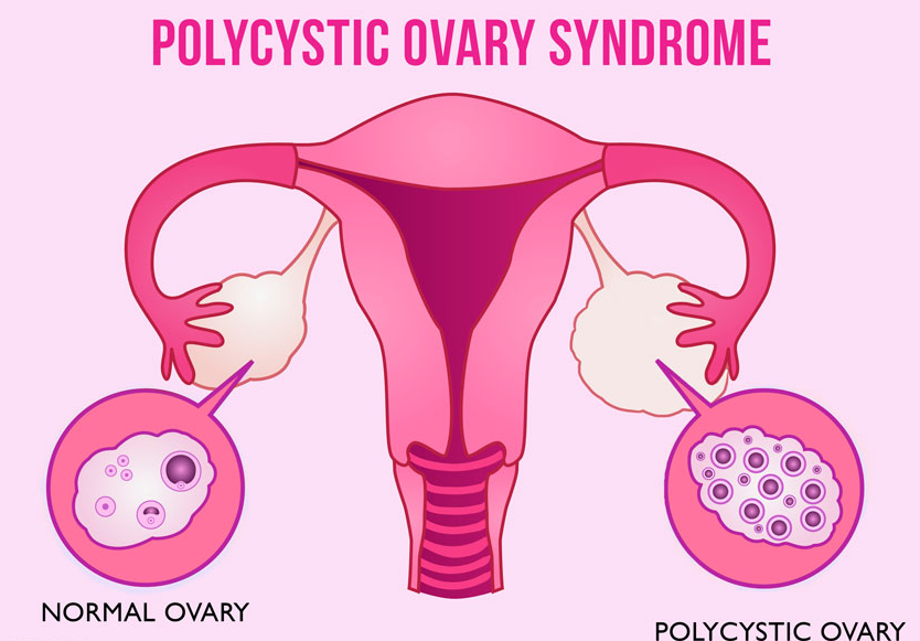 PCOS and their symptoms.